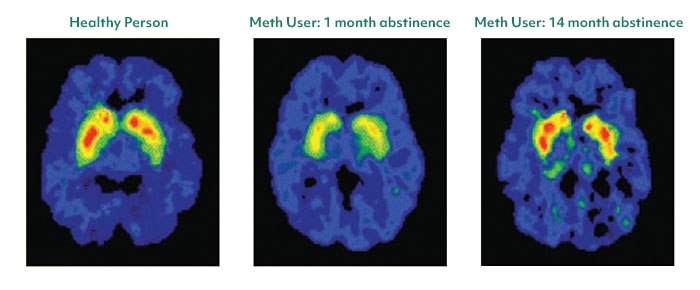 Brain scans show recovery from methamphetamine