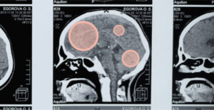 X-ray images of a person's cranium, with peach-colored spots highlighting different sections of the brain. Kinds of cravings and how to combat them.