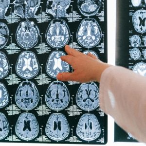 A doctor points at something on a brain scan